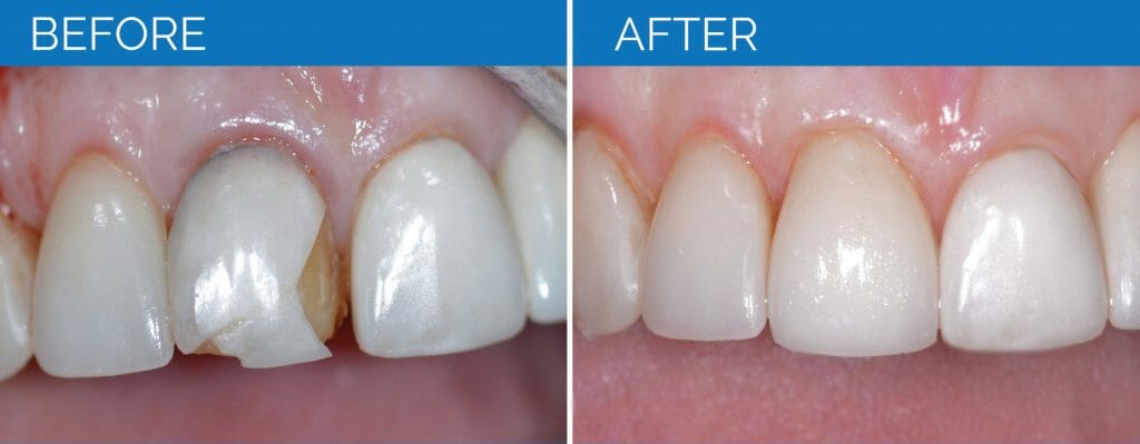 Before and After Chipped Tooth